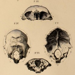 Bones. IV. From the bones of the head: coronal